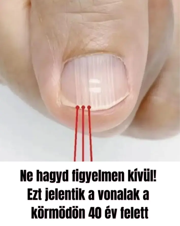 Miért jelennek meg a függőleges vonalak a körmön?
